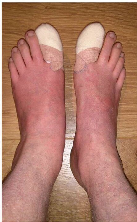 Creolin pentru ciuperca unghiilor de la picioare tratamentul ciupercilor pe degete și unghii de la picioare